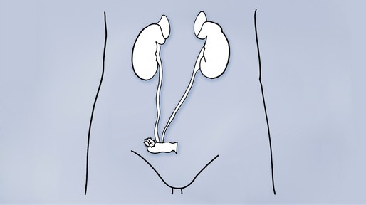 urinestoma